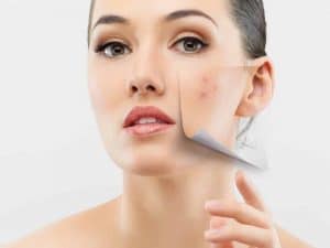 Surprisingly Good News About Acne: The Youth Recipe|Skin Care>Professional Skin Care