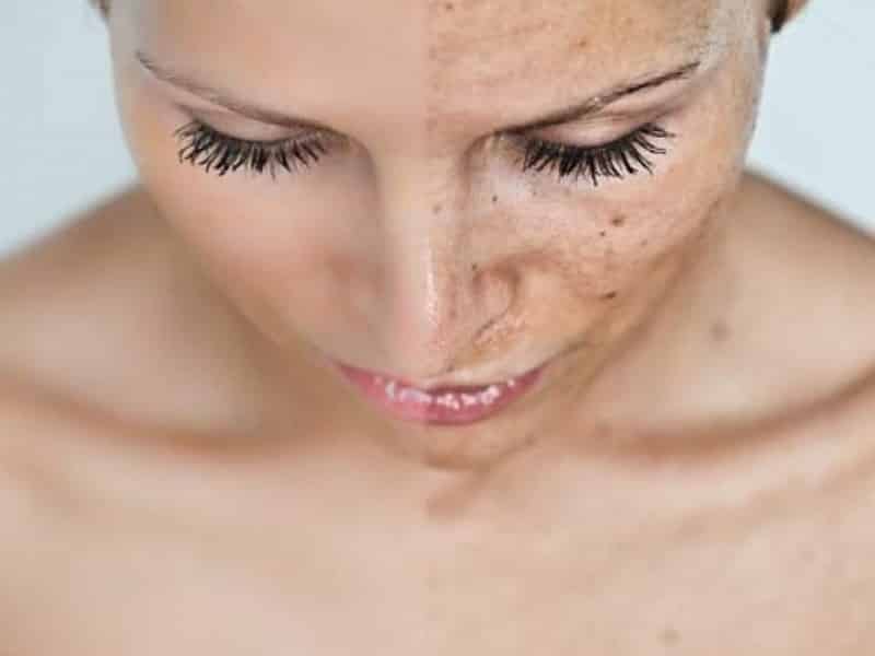 3 Types Of Chemical Peels To Know About|Beauty